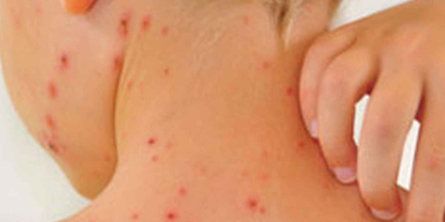 Dünya Sağlık Örgütü’nden kızamık uyarısı