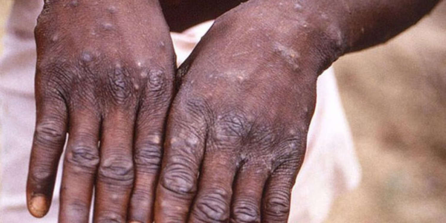 DSÖ, maymun çiçeği salgını nedeniyle 'küresel acil durum' ilan etti