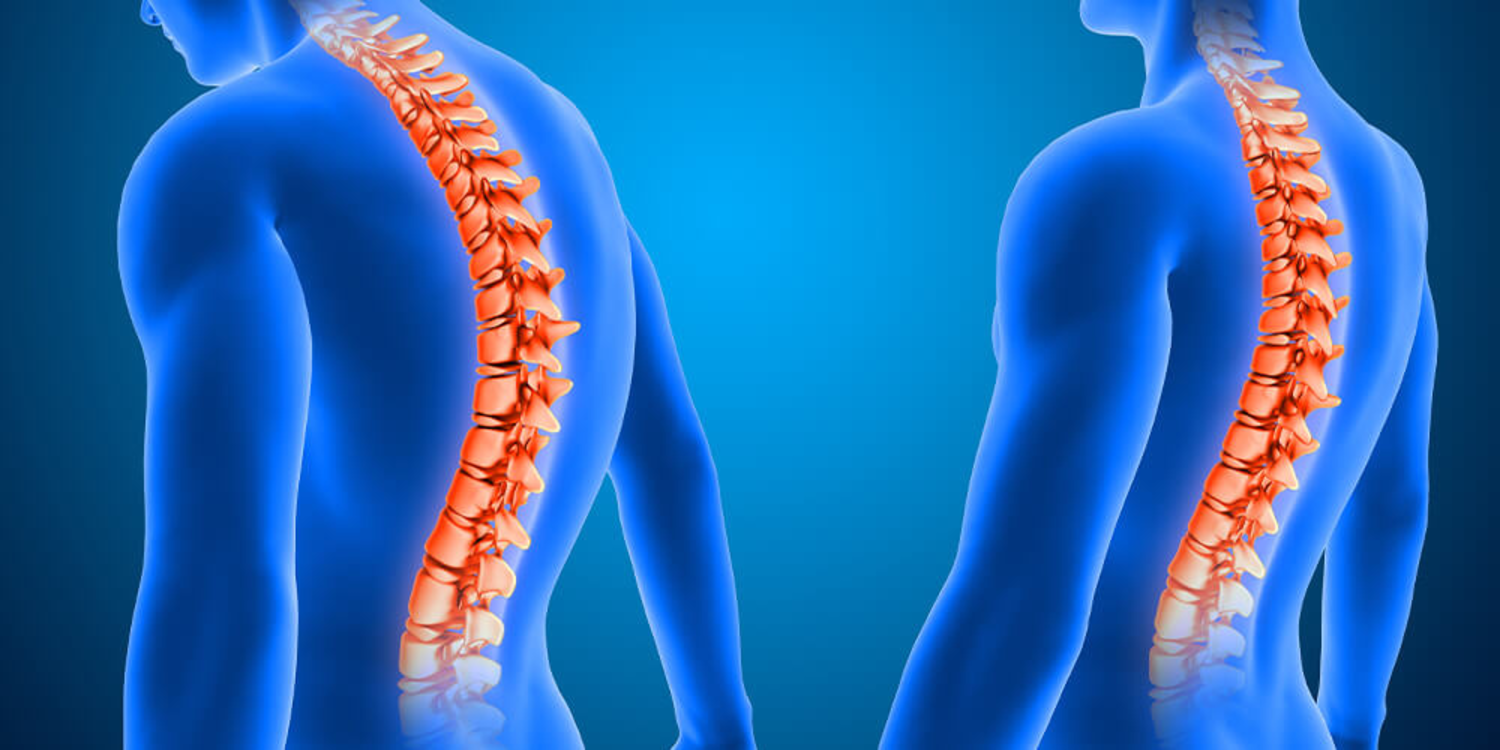 Skolyozda üç boyutlu tedavi dönemi